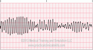 Ventricular Tachycardia Torsade de Pointes EKG strip