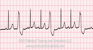Premature Ventricular Complex Trigeminy EKG strip